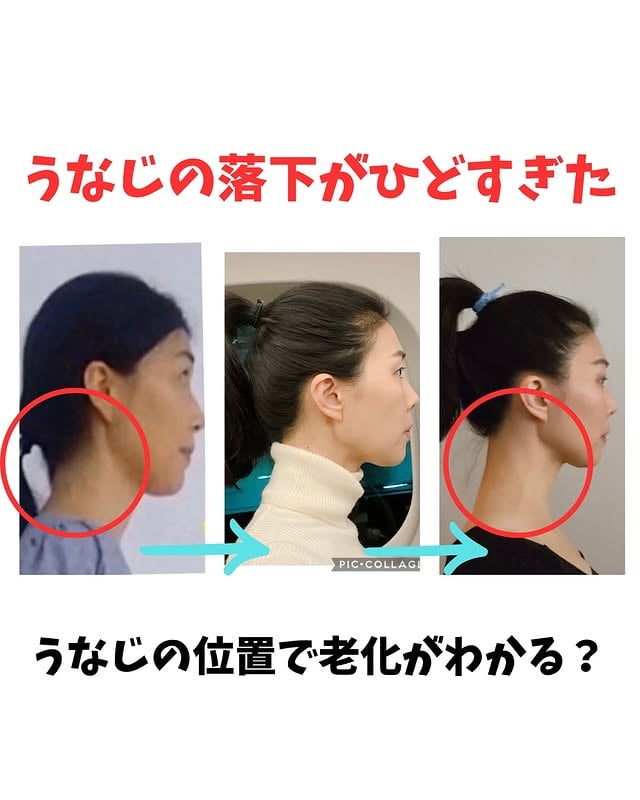 ▷うなじの位置で骨格老化（崩れ）がわかる？⇨うなじの位置から骨格を分析うなじが下がると（頭蓋骨が落ちている）お尻（骨盤）も同時に下がってきます。つまり！！顔の骨格とうなじを見るだけでわかるわけです。筋肉や脂肪にアプローチではなく骨格から変えるから、顔が小さくなるレベルではなくガラリと別人レベルで変わるわけです。※うなじ脱毛はしていませんよ#骨格の面白さ#骨格理論#うなじの位置#別人レベル#骨格小顔#骨格ボディメイク by @mona.risa.mm