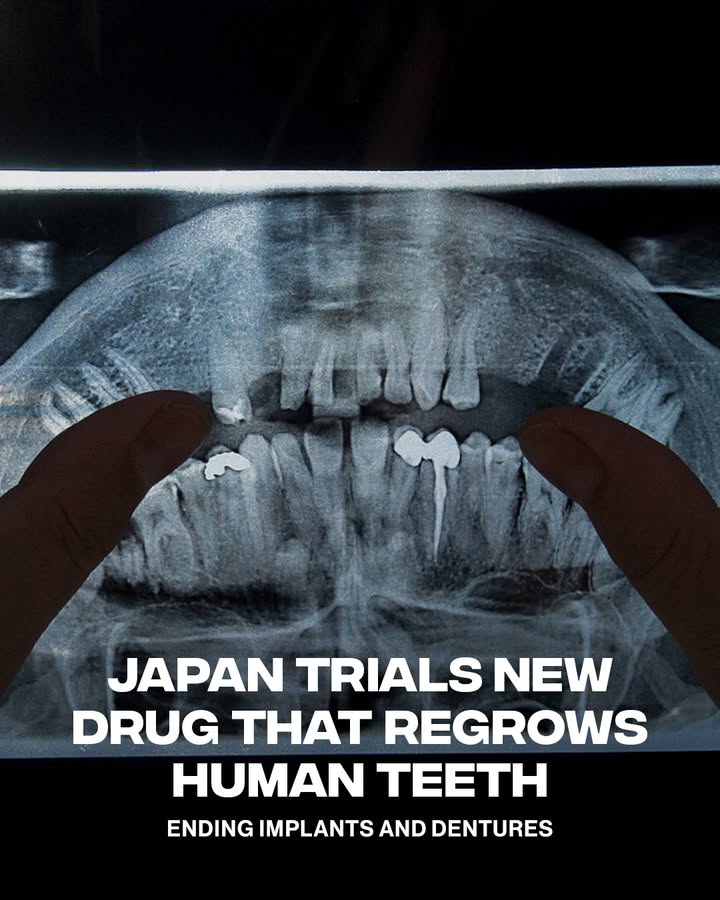 Japan is on a different level.
ㅤ
Japan has started the world’s first human trials of a new drug that could help people grow new teeth. The drug, called TRG-035, was developed by researchers at Kyoto University and Toregem Biopharma. It works by blocking a protein called USAG-1, which may activate dormant tooth buds and trigger the growth of a new set of teeth. If the trials are successful, the treatment could be available by 2030.
ㅤ

📸: @gettyimages