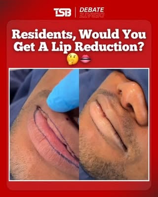Lip reductions may be the newest trend as some people move away from the fuller lip look and opt for something more natural 👀💉

Residents, would you ever get a lip reduction? 🤔

#TSBTalks #TSB